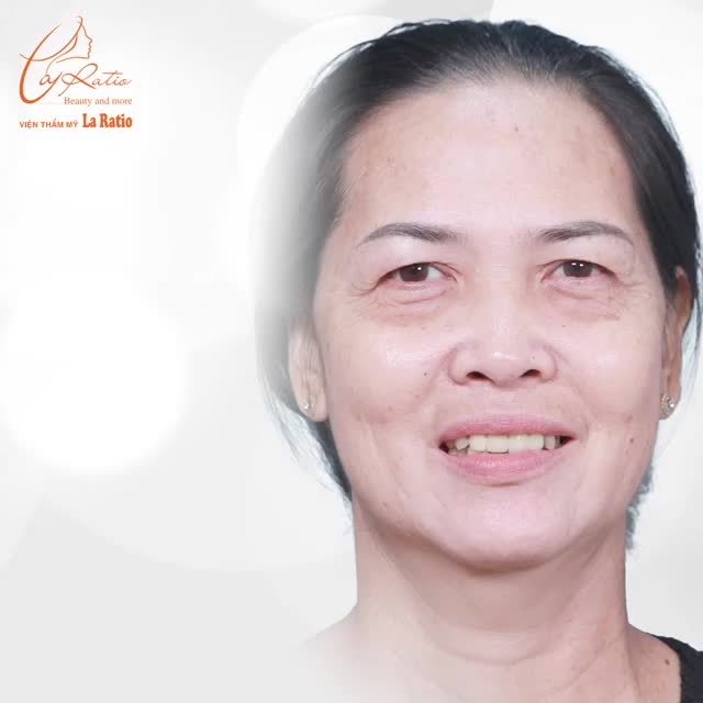 GIẢI PHÁP VÀNG LẤY LẠI VẺ ĐẸP THANH XUÂN CHO ĐÔI MẮT