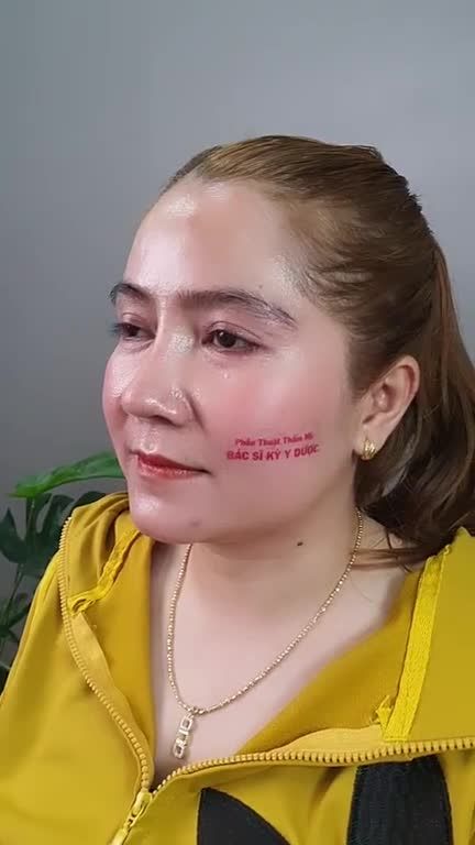 NÂNG MŨI  ALINE BCT 2 Lớp 4 tháng tuổi