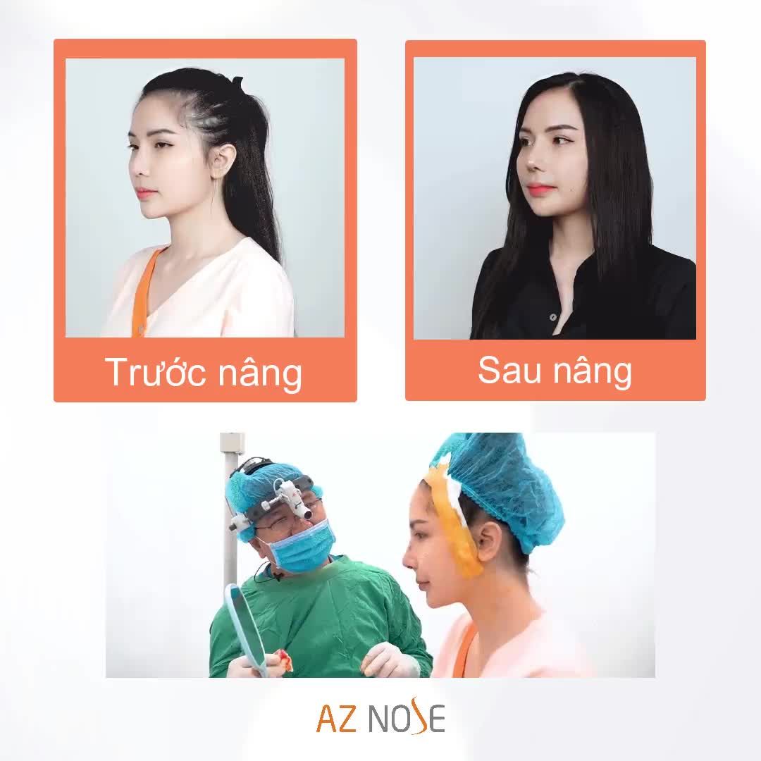 ĐẦU MŨI CỤP do sụp trụ đã được bác sĩ AZ NOSE "biến hóa" thành chiếc mũi cao xinh, không còn khuyết điểm