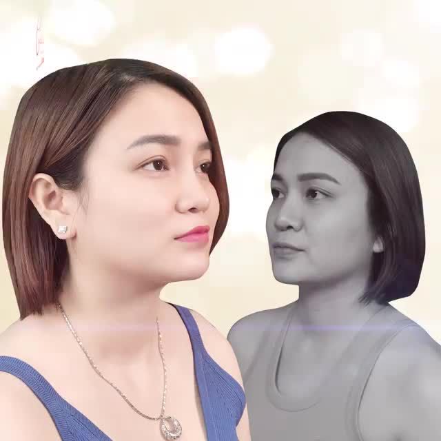 NÂNG MŨI MEGA S – “GIẢI CỨU” MŨI HỎNG – KHẮC PHỤC BIẾN CHỨNG ‼