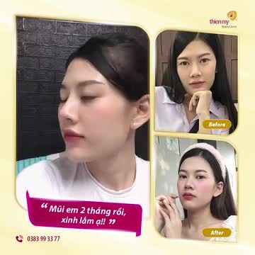 Thả tim cho sự xinh đẹp này ạ! Feedback "xịn sò" của khách hàng sau 2 tháng nâng mũi tại Thiện Mỹ.