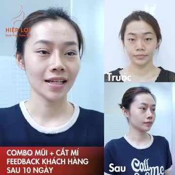 Feedback của khách hàng sau 10 ngày - COMBO NÂNG MŨI + CẮT MÍ