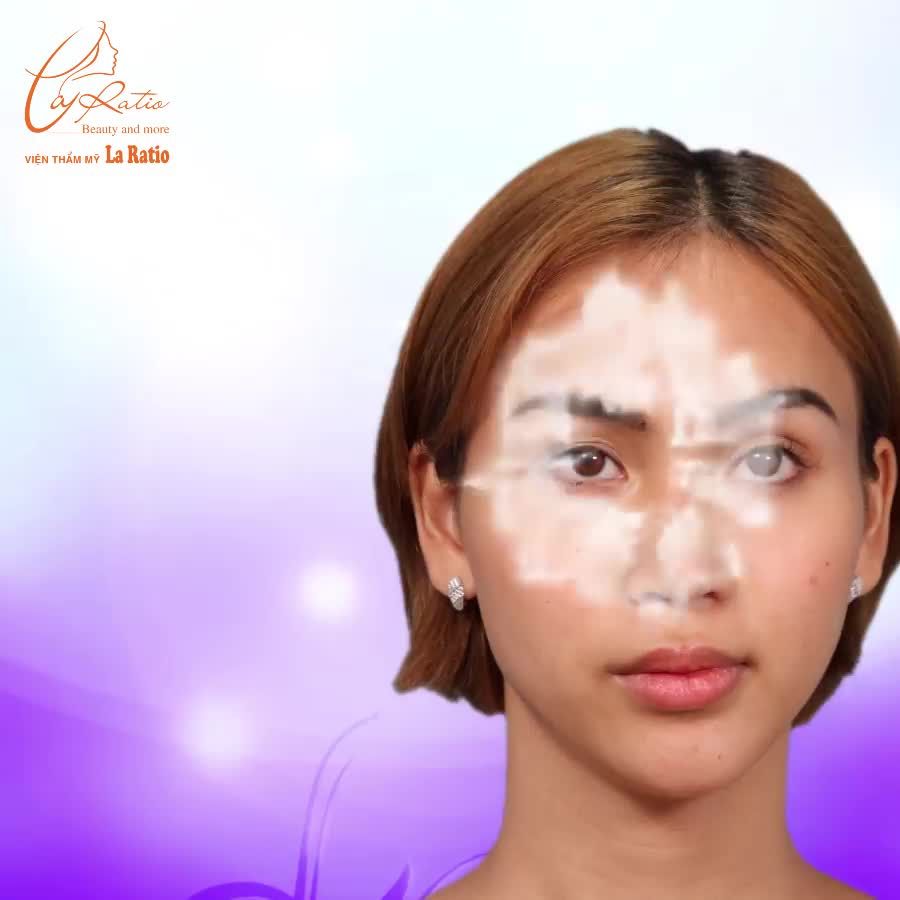 CẮT MÍ ILID - TẠM BIỆT ĐÔI MẮT BÉ - KHÔNG RÕ MÍ ‼