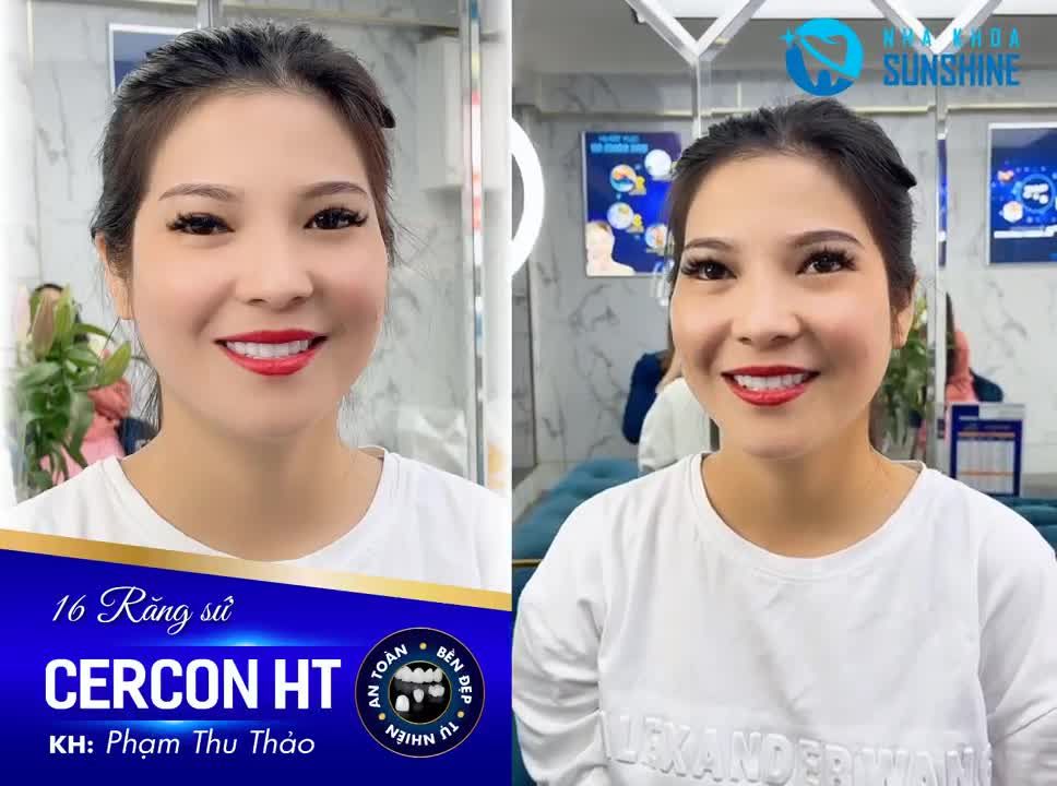 RĂNG SỨ CERCON HT – ĐẸP HOÀN HẢO, CHUẨN TỰ NHIÊN