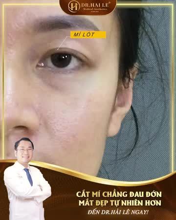CẮT MÍ DR.HẢI LÊ – LÀM LÀ ĐẸP – NGĂN CHẶN TỐI ĐA MÍ LỖI, HỎNG