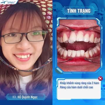 Hồ Quỳnh Ngọc đã sở hữu nụ cười rạng rỡ và một diện mạo xinh xắn hơn sau khi niềng răng.