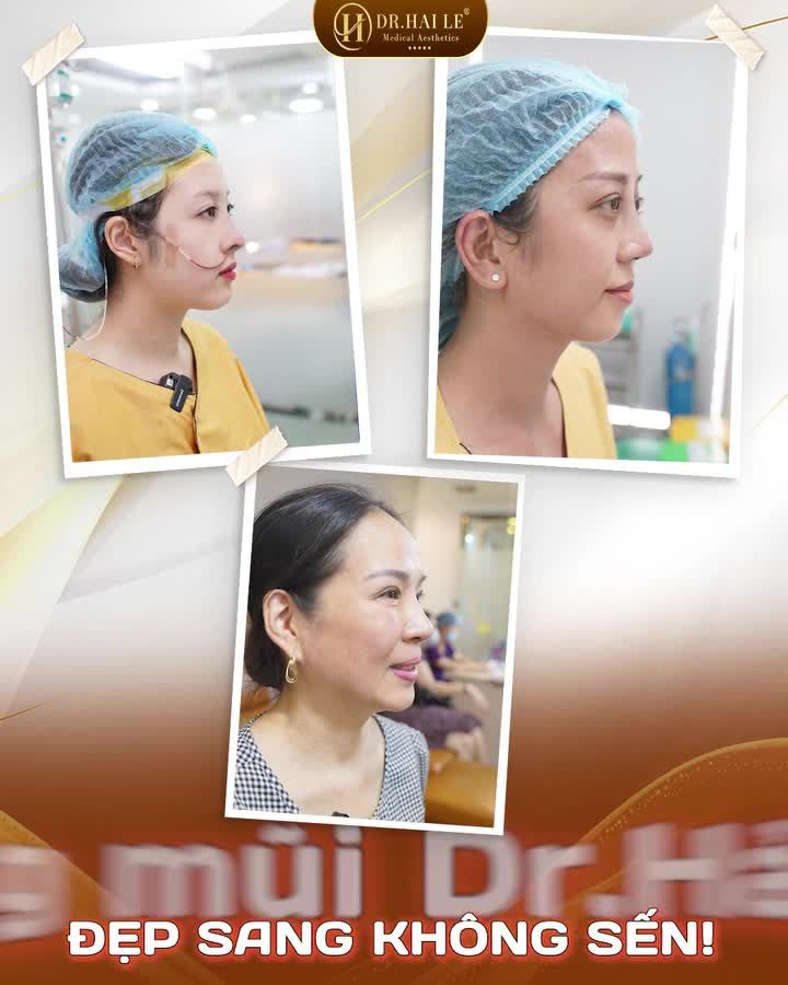 Sống mũi thấp, đầu mũi to, có cách nào thay đổi dáng mũi nhanh chóng mà không gây đau đớn kéo dài?