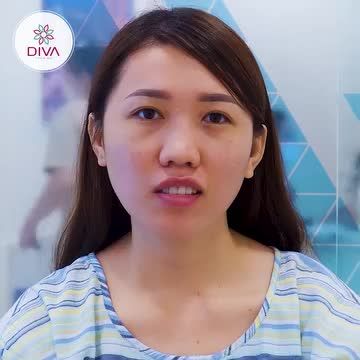 LẤY MỠ MÍ DƯỚI, TIÊM MỠ COLEMAN MẶT KẾT QUẢ SAU 3 TUẦN NHƯ THẾ NÀO?