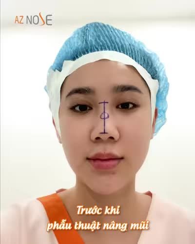 Video này sẽ lý giải vì sao bạn nên chọn nâng mũi trước tiên nếu muốn xinh đẹp hơn! Cùng theo dõi nhé!