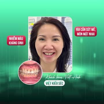 VIỆT KIỀU SÉC ĐÁP CHUYẾN BAY VỀ VIỆT NAM, CHỌN NHA KHOA GIA ĐÌNH THẨM MỸ RĂNG SỨ