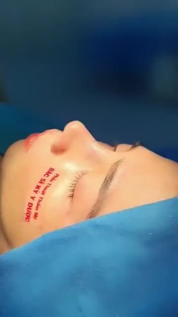 Bác sĩ Kỳ Y Dược vừa thực hiện xong ca Phẫu thuật Nâng mũi ALINE Sụn tai 2 lớp.