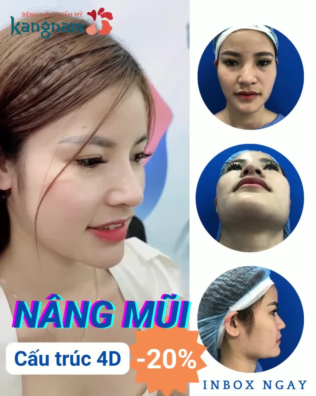 Nâng mũi xong xinh hết nước chấm