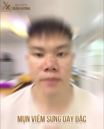 Mụn không hề khó chữa nếu bạn chọn đúng phương pháp!