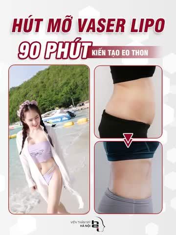 HÚT MỠ VASER LIPO 90 PHÚT KIẾN TẠO EO THON TẠI VIỆN THẨM MỸ HÀ NÔI