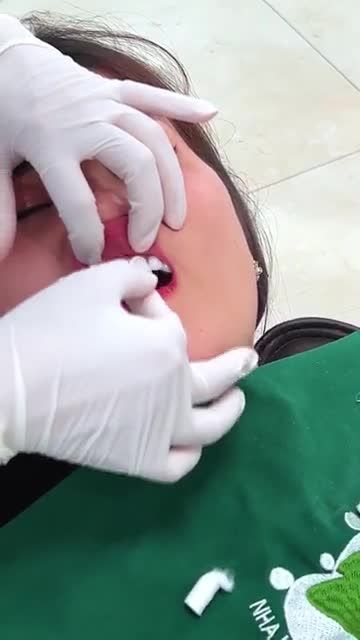 QUÁ TRÌNH LẮP 16 ĐƠN VỊ SỨ CHO VỊ KHÁCH XINH ĐẸP ĐẾN TỪ HẢI DƯƠNG