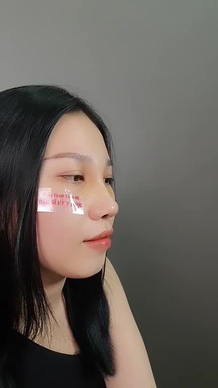 Như thế nào là 1 công đôi việc Nâng mũi ALINE - vừa thẩm mỹ, vừa hợp phong thủy.
