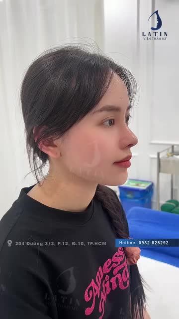 MŨI SỬA LẠI CẤU TRÚC SỤN TAI SÓNG SURGIFORM SAU 10 NGÀY