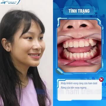 Nguyễn Thị Thanh Huệ đến với Nha khoa Lạc Việt Intech trong tình trạng răng bị khấp khểnh, khớp cắn hở