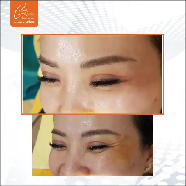 TIÊM BOTOX XÓA NHĂN ĐUÔI MẮT – LẤY LẠI THANH XUÂN CHỈ SAU 10’