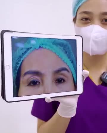Xơ sẹo được loại bỏ, bác sĩ can thiệp căn chỉnh cơ nâng mi, bóc tách co dính mô xơ và chỉnh hình sắp xếp lại ổ mí mắt lỗi hỏng trước đó.