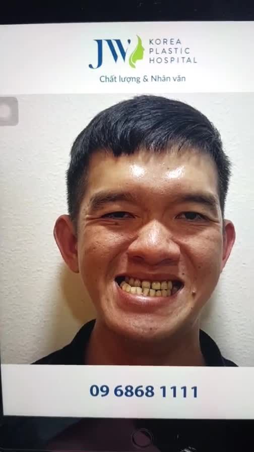 MÊ MẨN với KẾT QUẢ PHẪU THUẬT HÀM MÓM + NIỀNG RĂNG đẹp chuẩn HOTBOY của anh chàng MẶT LỆCH Trước đây, tình trạng của anh bị hàm móm, lệch và răng lộn xộn rất nhiều khiến anh luôn cảm thấy tự ti và mặc cảm.