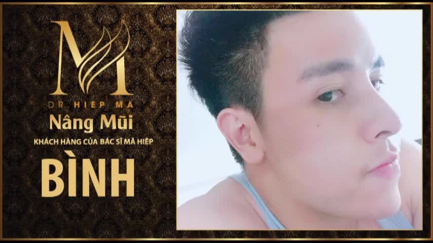 Nâng mũi - Bác sĩ Mã Hiệp - Ca 41