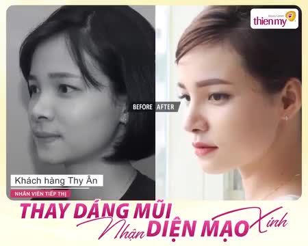 ẤT NGỜ TRƯỚC KẾT QUẢ NÂNG MŨI TẠI VTM THIỆN MỸ