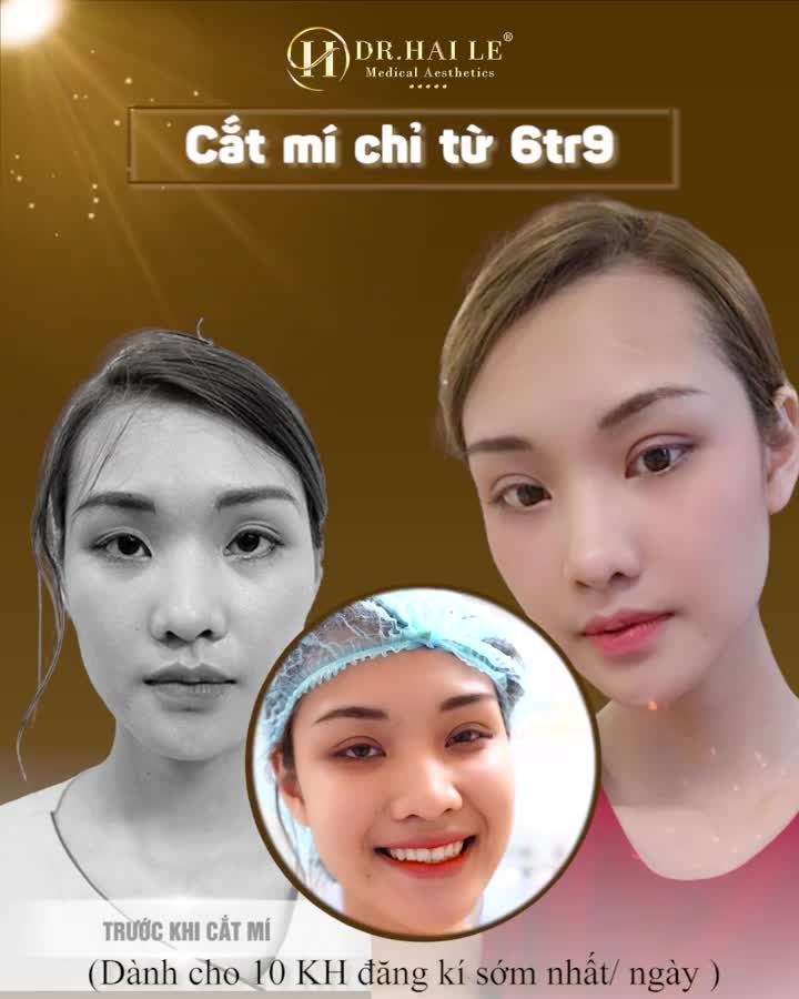 HẾT NHIỀU NẾP/SỤP MÍ - MẮT ĐẸP ƯNG HẾT Ý