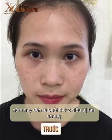 Mới trải nghiệm 1 buổi trị tàn nhang mà khách hàng ưng ý thế này đây