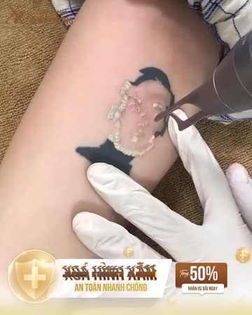 Công nghệ Mela Picosure giúp xóa xăm hiệu quả, máy đi đến đâu mờ mực xăm đến đó. NHẸ  NHÀNG - NHANH CHÓNG - SẠCH MỰC - KHÔNG BỎNG RÁT