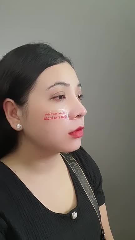 Nâng Mũi ALINE bán cấu trúc 2 lớp Dáng mũi đẹp chuẩn sau 6 tháng.