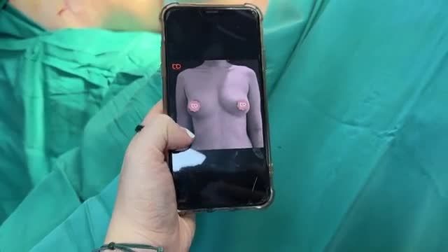 Đã có kết quả ca combo nâng ngực + hút mỡ bụng rồi các chị em ơi.