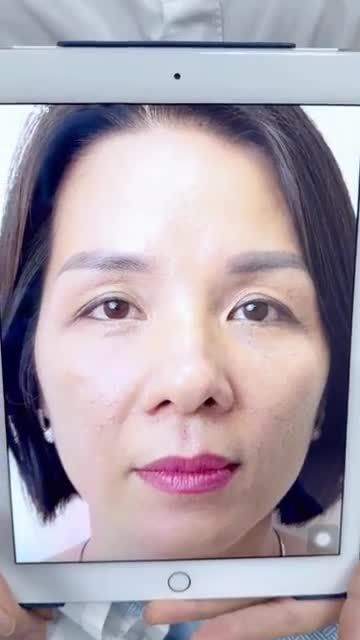Cả nhà cùng xem và cho đánh giá kết quả ca nâng cung mày này nhé