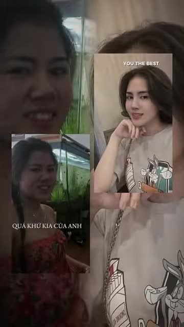Sự thay đổi ngoạn mục của bạn khách Nâng mũi Aline tại Bác sĩ Kỳ Y Dược.