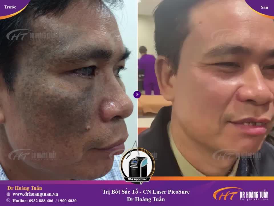 Nay bác sĩ và chú vui mừng quá! Hình ảnh chú Đạt đến từ Thái Bình kết thúc liệu trình trị bớt sắc tố