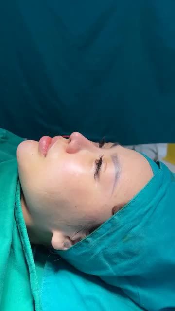 Case mũi cấu trúc sửa lại vừa hoàn thành