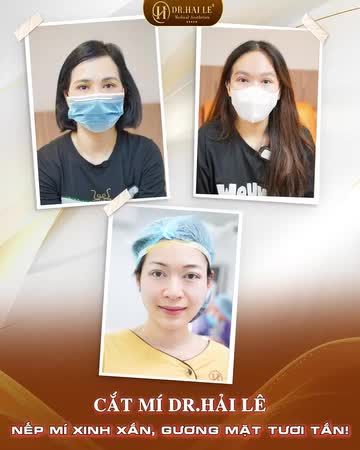 CẮT MÍ DR.HẢI LÊ – LÀM LÀ ĐẸP – NGĂN CHẶN TỐI ĐA MÍ LỖI, HỎNG