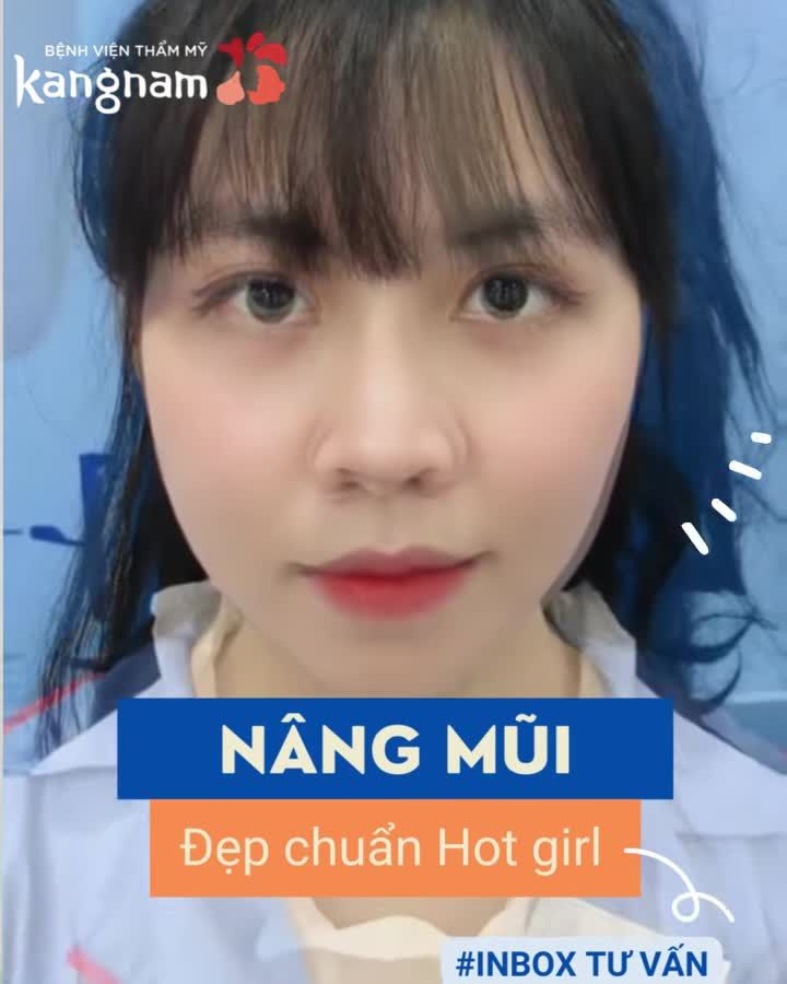 Nâng mũi auto xinh và đây là minh chứng