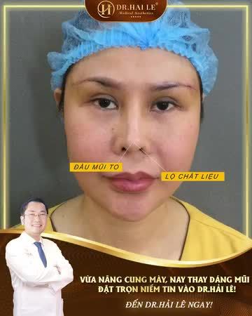 Đôi mắt nhiều da chùng, mỡ thừa cùng dáng mũi cũ sau 2 năm nâng bị co rút, khiến vị khách hàng tự ti...