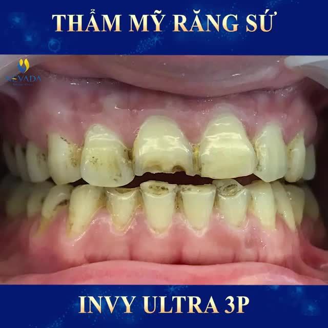 GIẢI PHÁP NÀO CHO HÀM RĂNG SỨT MẺ, XỈN MÀU, MÒN MẶT NHAI??