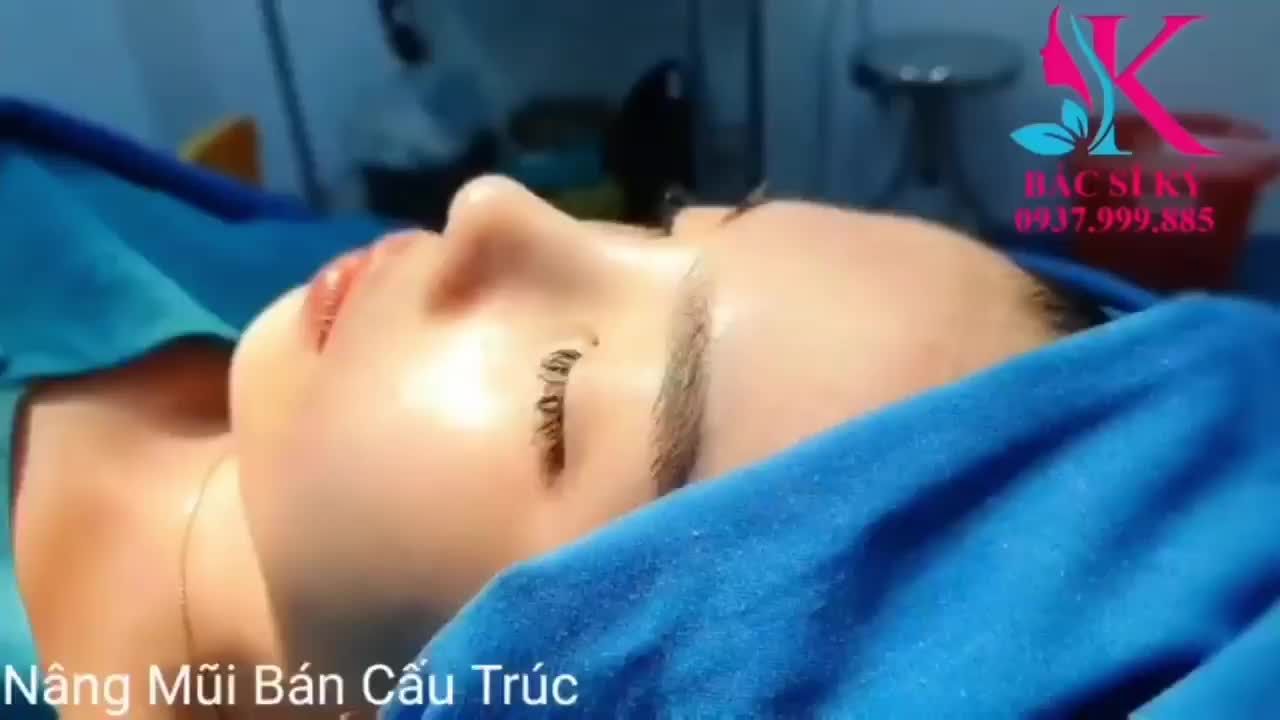 Nâng Mũi Bán Cấu Trúc Sụn Tai sau 45 phút KHÔNG ĐAU- KHÔNG SƯNG BẦM