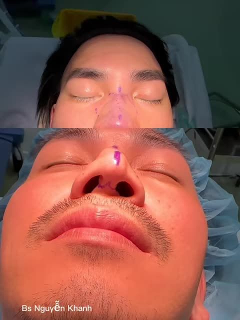 Xem thêm 18 video Nâng Mũi của bác sĩ Bs Nguyễn Khanh
