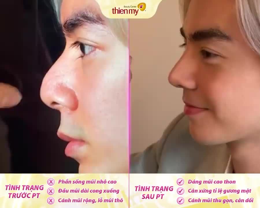Mũi diều hâu sau khi được Thiện Mỹ độ dáng sẽ trông như thế nào?