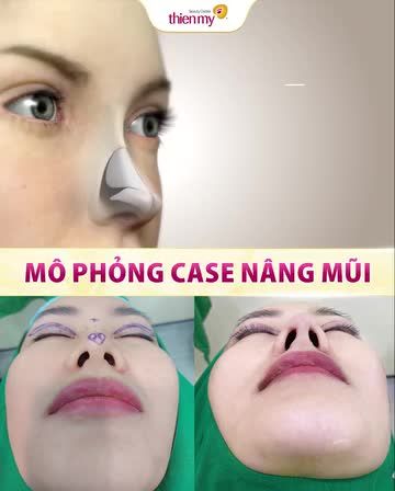 1 case nâng mũi tại VTM Thiện Mỹ sẽ được thực hiện như thế nào?