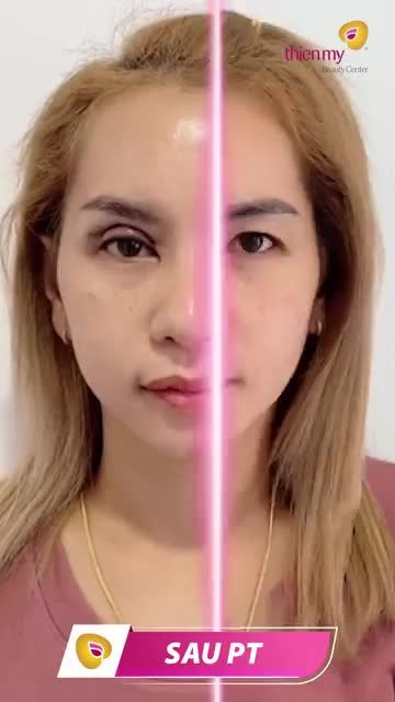 Tạo hình mắt 2 mí chỉ 30 phút - khách hàng sẽ sở hữu diện mạo hoàn toàn mới, ĐẸP - SANG và tự tin hơn!