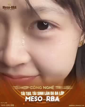  Trải nghiệm Tổ hợp công nghệ trị liệu Meso-RBA cực ưu việt với giá thành hợp lý, chỉ có tại Dr.Hải Lê!