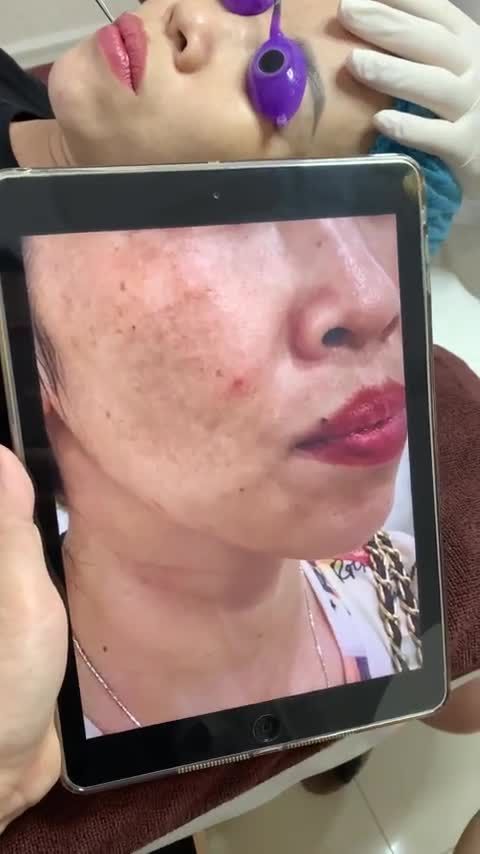 Trị nám buổi 2