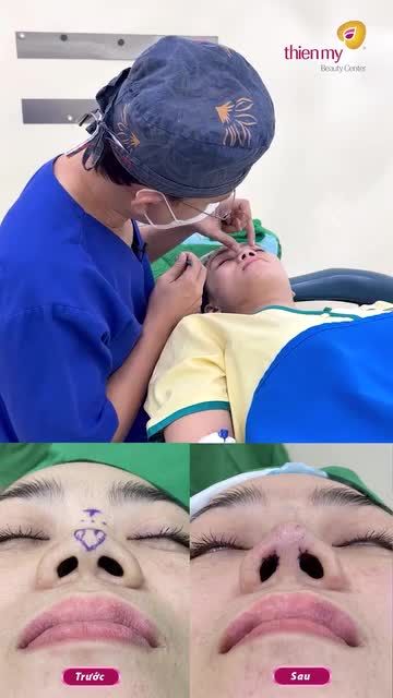 LẮNG NGHE BÁC SĨ PHÂN TÍCH DÁNG MŨI KHÁCH HÀNG TRƯỚC KHI THỰC HIỆN PHẪU THUẬT