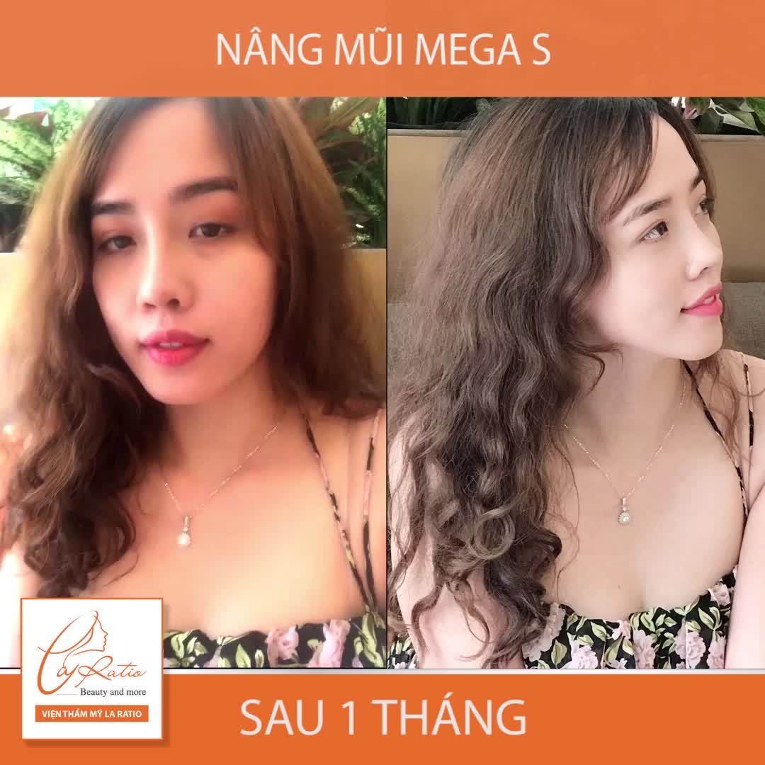 VÌ SAO THỜI BUỔI NÀY 10 NGƯỜI THÌ HẾT 9 NGƯỜI MUỐN NÂNG MŨI
