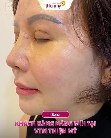 NÂNG MŨI ĐẸP – SANG – XỊN Chọn ngay Thiện Mỹ